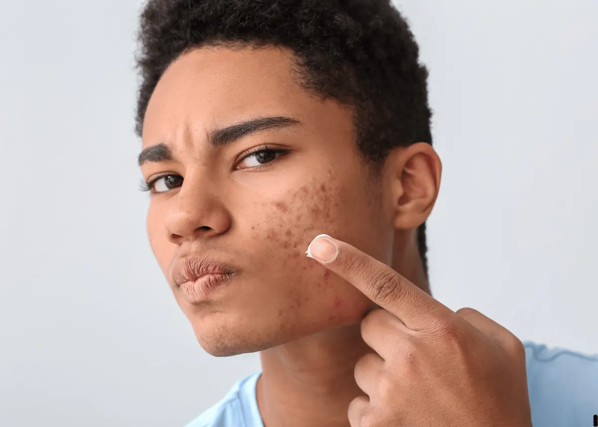 Face Reality acne skincare products used in the at-home care routine for the Acne Healing Program