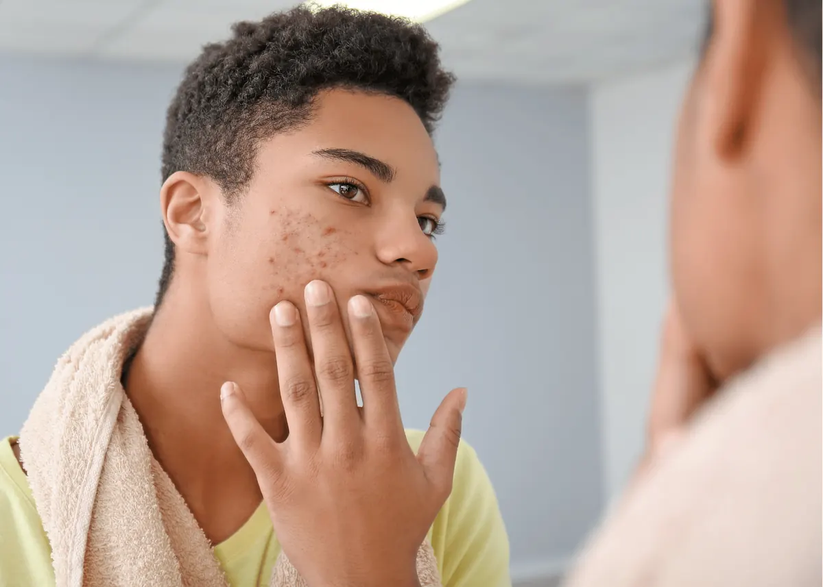 Professional acne facial mask treatment being applied by a licensed esthetician at Safe Haven Spa